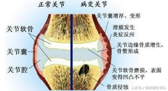 一個民間治癒率極高的「骨質增生」配方，基本上都是一副藥既愈，不再復發！