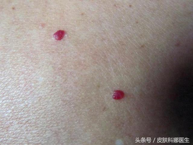 皮膚上突然長出「紅痣」，是衰老特徵，還是皮膚腫瘤？快聽聽醫生的說法！