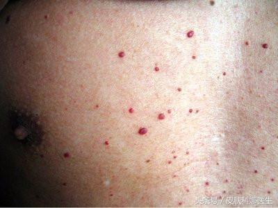 皮膚上突然長出「紅痣」，是衰老特徵，還是皮膚腫瘤？快聽聽醫生的說法！