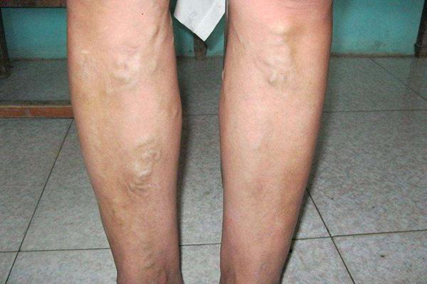 熱水泡腳有益健康？這6類人可能會泡出「麻煩」，希望沒有你