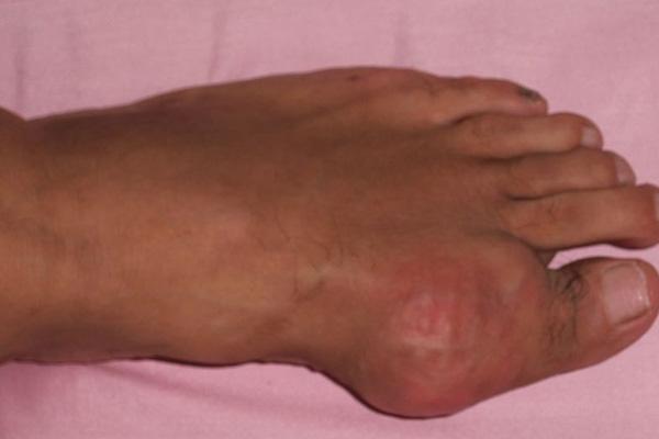 熱水泡腳有益健康？這6類人可能會泡出「麻煩」，希望沒有你