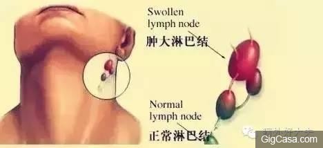 脖子有腫塊除了淋巴出問題，竟然還有其他原因！別再嚇自己了！