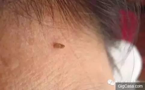 脖子有腫塊除了淋巴出問題，竟然還有其他原因！別再嚇自己了！