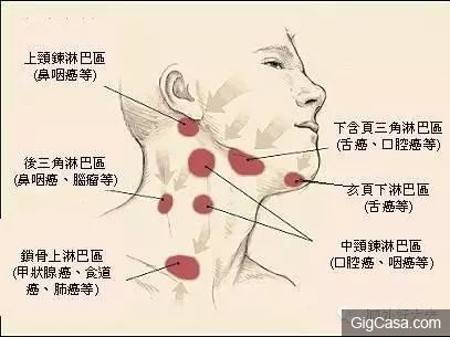 脖子有腫塊除了淋巴出問題，竟然還有其他原因！別再嚇自己了！
