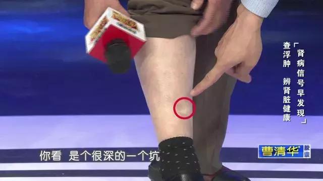 一定不要這樣喝水，會「毀掉」自己的腎，出現這種症狀表示腎臟受損