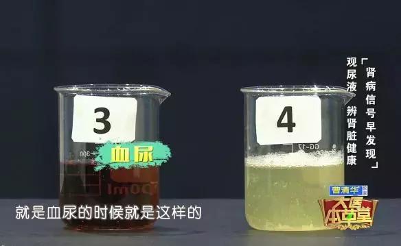 一定不要這樣喝水，會「毀掉」自己的腎，出現這種症狀表示腎臟受損