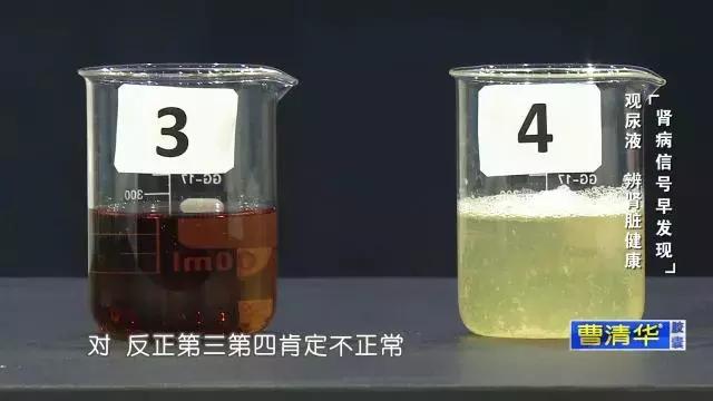 一定不要這樣喝水，會「毀掉」自己的腎，出現這種症狀表示腎臟受損