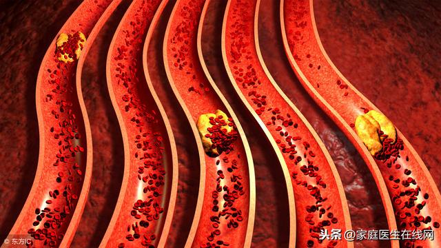 血管堵塞時，會頻頻發出這7個「警告」，要重視起來