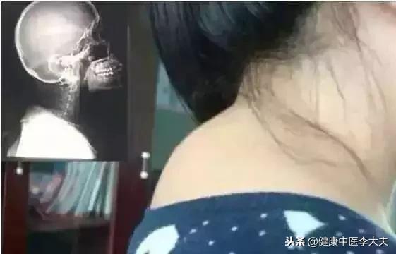 脖子後面的大椎穴，「克制」頸椎病，收藏了！