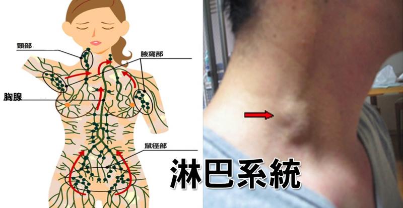  「肥胖」、「癌細胞」的幕後黑手是「淋巴堵塞」！5招「淋巴暢通法」排毒消腫「免花錢」