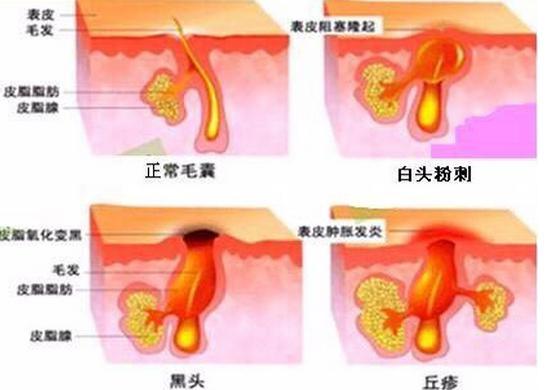 痘痘消了沒隔幾天又出現？這四種行為你是不是也經常做
