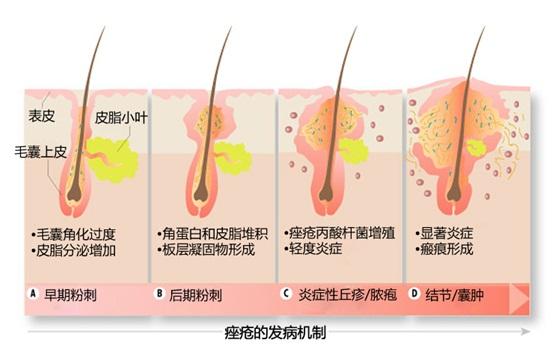 痘痘消了沒隔幾天又出現？這四種行為你是不是也經常做