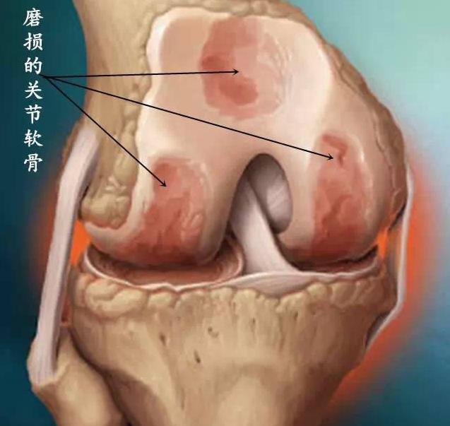 生薑+綠豆真厲害，每天吃一碗，【祛濕消炎、活血化瘀】膝蓋不疼，滑膜炎積液也拜拜了