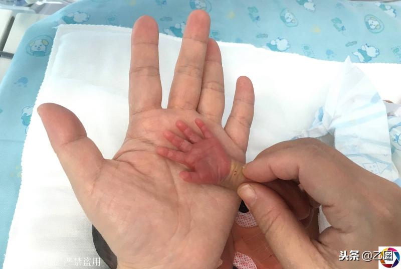 孕婦懷孕6個月在家產「掌心寶寶」，急壞家人，住保溫箱2月活下來