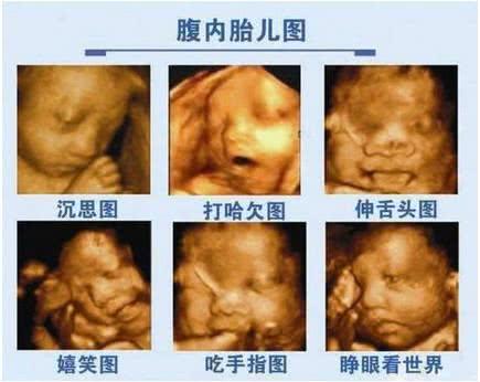 懷孕6個月做孕檢，發現胎兒唇齶裂嚴重，預防唇齶裂這兩點要做好