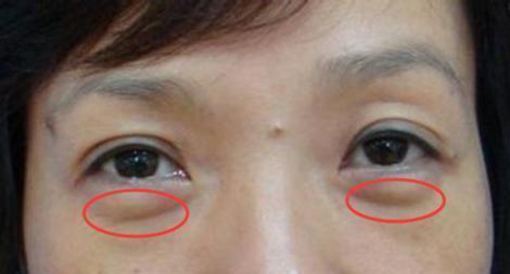 女人有眼袋愛打玻尿酸？別傻了！塗點廚房便宜貨，兩周撫平眼袋