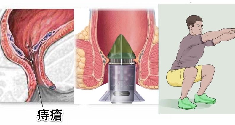 太好了，痔瘡終於有解了！教你三種方法自然消除，人人都能不再癢！只要這樣做...簡簡單單！!