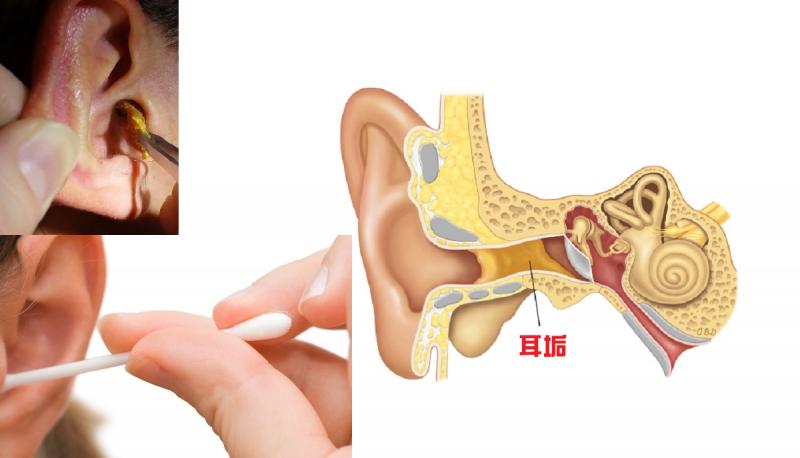 「耳鼻喉科」教授告訴你：「耳垢」不是垢！三要訣：別掏、別挖、別清理！ 