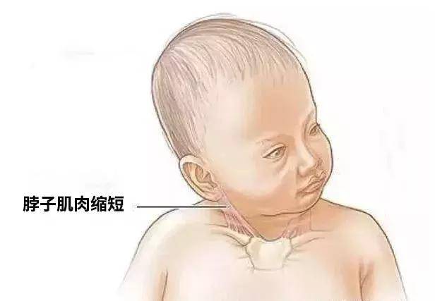 只因為抱姿不對，她讓寶寶成了斜頸