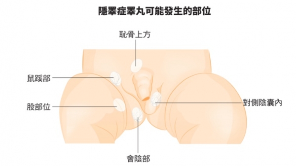 手殘醫「裝錯邊」！隱睪症變...2歲男童從此變公公！媽媽崩潰：人生全毀