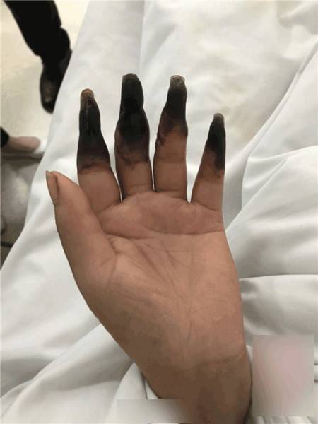 婦人打掃完家裡「8根指頭焦黑」慘變枯枝！連醫生也搖頭嘆：她太粗心了