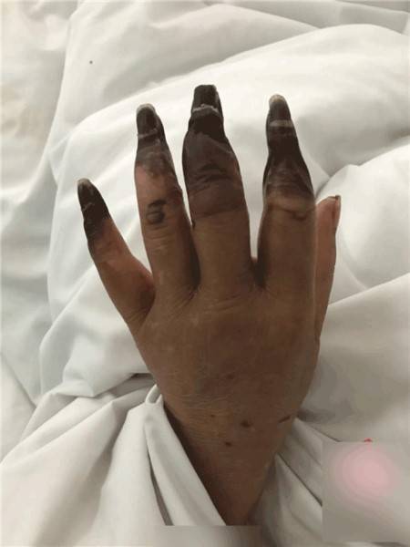 婦人打掃完家裡「8根指頭焦黑」慘變枯枝！連醫生也搖頭嘆：她太粗心了