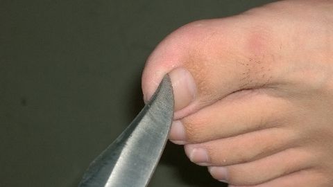 趾甲又長到肉裡了？教你一招，輕松去除！（收藏）