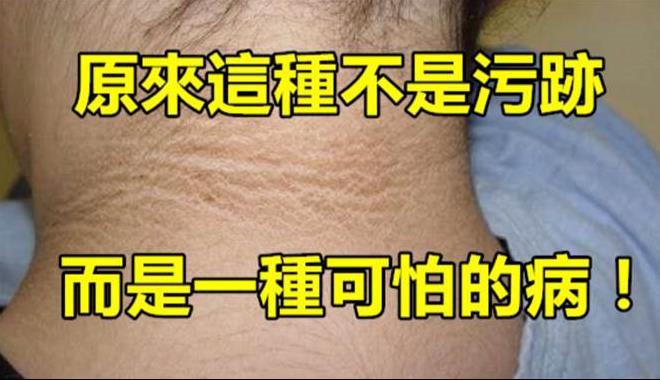 女孩脖子上有一圈洗不掉的髒汙，去檢查時醫生的話嚇壞了大家，紛紛檢查自己有沒有！