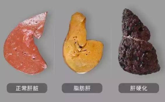 喜歡喝酒的人，晚上睡覺若沒有這4種症狀，恭喜你，肝臟比較健康！