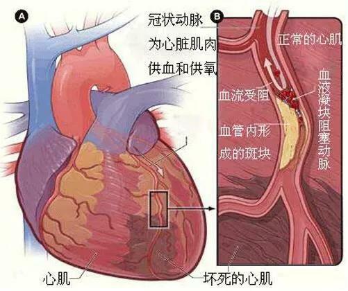 急性胸痛鑑別非常重要，三種極易致死的胸痛該如何鑑別 