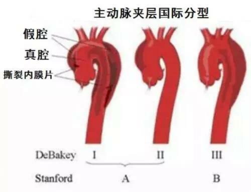 急性胸痛鑑別非常重要，三種極易致死的胸痛該如何鑑別 