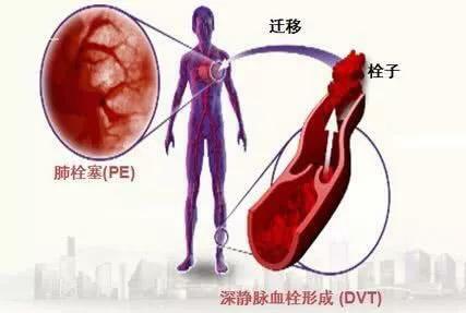 急性胸痛鑑別非常重要，三種極易致死的胸痛該如何鑑別 