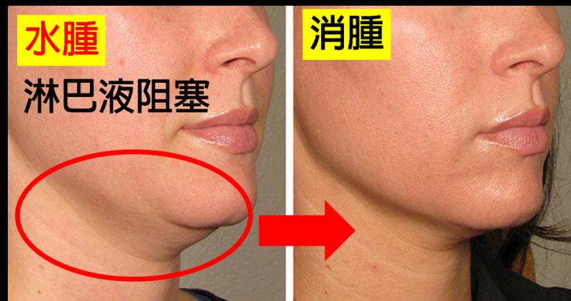 大圓臉不是胖是「水腫」！一秒學會「淋巴暢流按摩法」秒退水腫，雙下巴、泡泡眼自然消，「瓜子臉」迅速現形！
