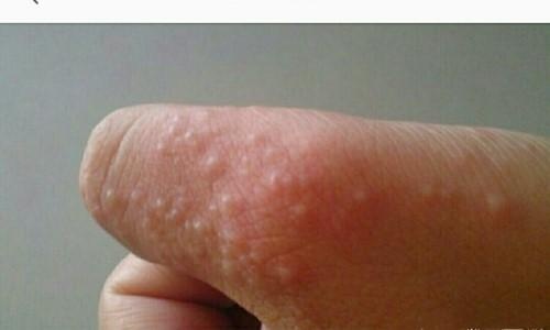 痛苦！手上突然起這種「小水泡」，很癢，抓破後有少量液體流出，該怎麼辦？教你一招，很快就好！