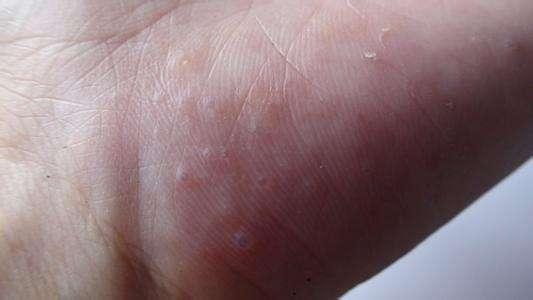 痛苦！手上突然起這種「小水泡」，很癢，抓破後有少量液體流出，該怎麼辦？教你一招，很快就好！