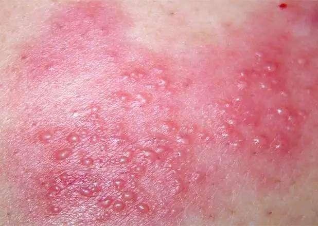 痛苦！手上突然起這種「小水泡」，很癢，抓破後有少量液體流出，該怎麼辦？教你一招，很快就好！