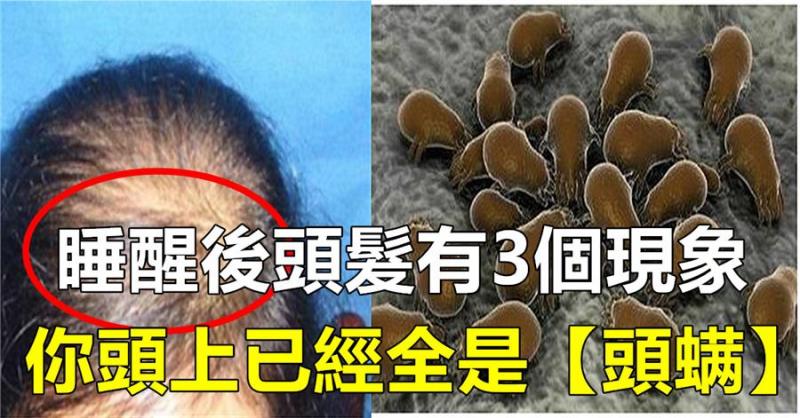 早上起來，頭髮有這3個現象，說明你頭上全是【頭蟎】了