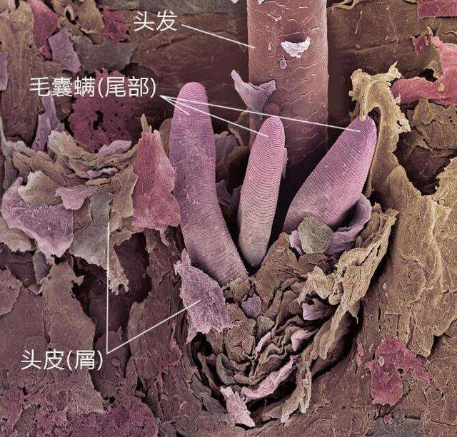 早上起來，頭髮有這3個現象，說明你頭上全是【頭蟎】了
