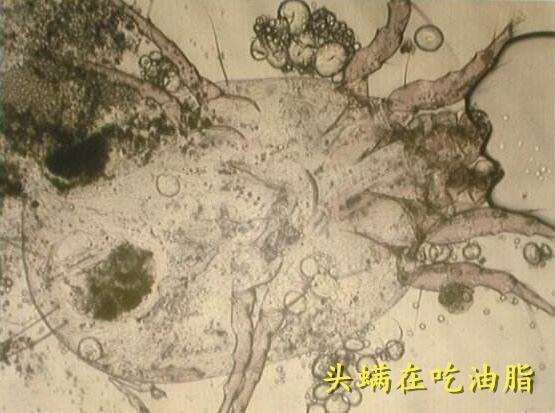 早上起來，頭髮有這3個現象，說明你頭上全是【頭蟎】了