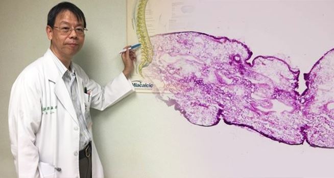  婦人突然「癱瘓」排尿也困難，切開脊椎發現「一大堆蟲」嚇壞醫生！