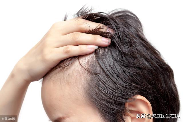 男性為什麼容易脫髮？主要是這幾個原因！