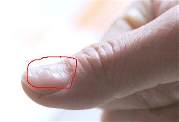 指甲出現這「5種狀況」千萬不要忽視，很可能是身體大病的前兆！ 