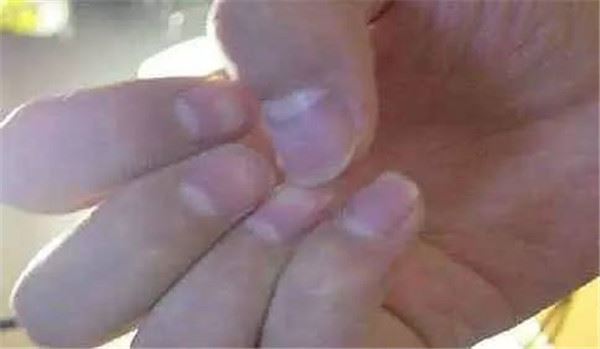 指甲出現這「5種狀況」千萬不要忽視，很可能是身體大病的前兆！ 