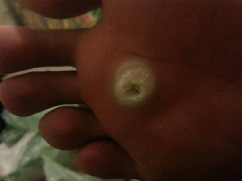 雞眼要根治？不難！只需要1個小方法就能辦到！而且操作簡單還便宜，不會有強烈疼痛感！