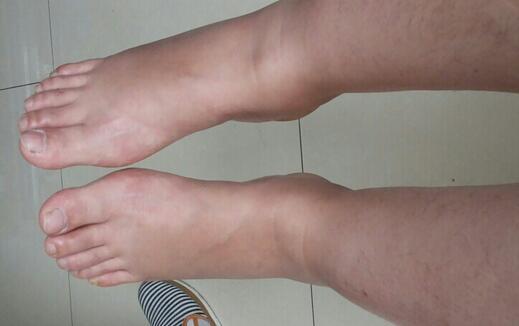 樹枯根先竭，人老腳先衰！腳部出現這幾種癥狀，請一定別忽視！可能是這些疾病的信號！ 