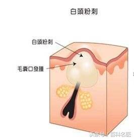 下巴上長出許多白色的小點點，是怎麼回事兒？該怎麼處理呢？