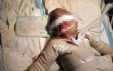 午睡奶奶開了一下空調，3歲美貌小女孩變成紗布人，女孩總和爸爸說：爸爸，我疼...打工父母傷心欲絕