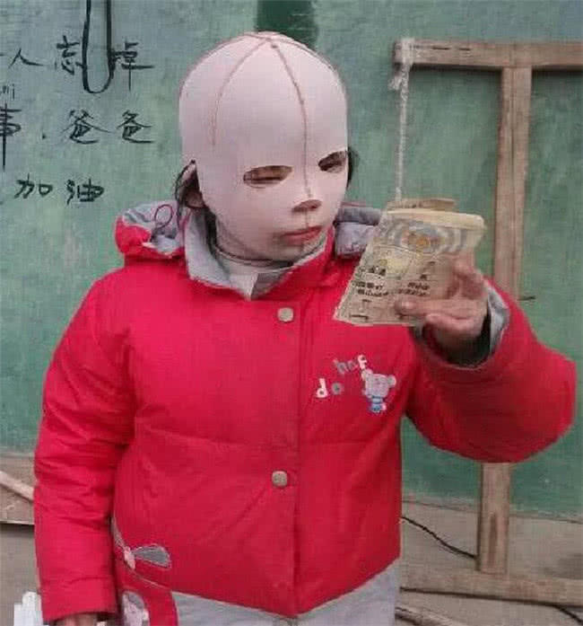 10歲女孩整天帶著「頭套」，同學都嘲笑她是「怪物」，摘下面具後眾人淚奔！