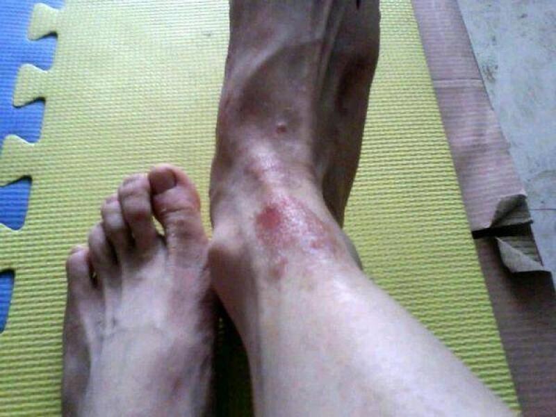 手腳裂口或嘴唇乾裂，老中醫教你這一招，3天見效哦。