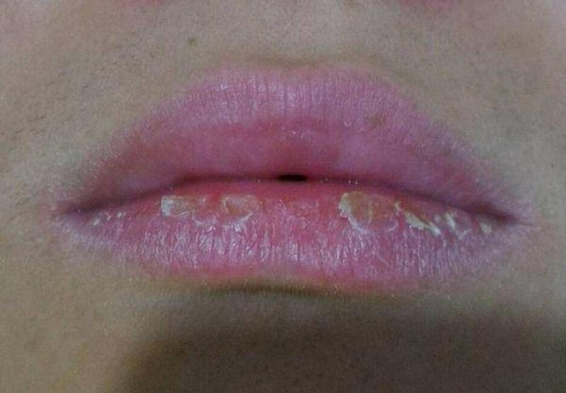手腳裂口或嘴唇乾裂，老中醫教你這一招，3天見效哦。